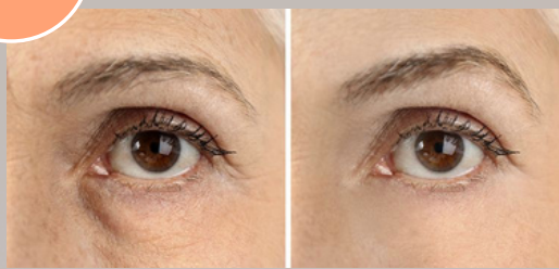 Tear Trough Filler Before and After