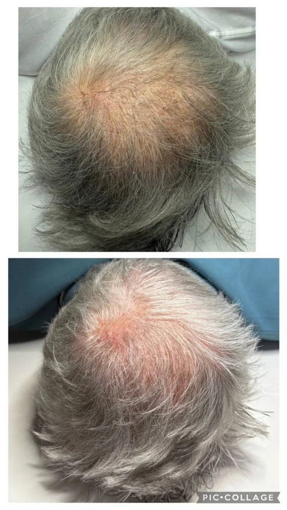 HAIR EXOSOMES